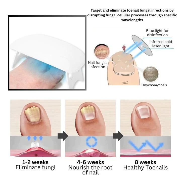 Oveallgo™ PROMAX Revolutionary Light Therapy Device For Toenail Diseases