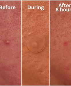 Oveallgo™ Nighttime Acne Patch