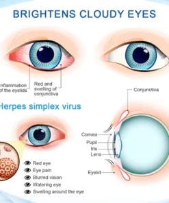 Oveallgo™ OptiVision Gotas para el tratamiento de los trastornos oculares