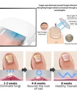 Oveallgo™ PROMAX Revolutionary Light Therapy Device For Toenail Diseases