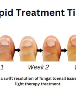 Oveallgo™ PROMAX Revolutionary Light Therapy Device For Toenail Diseases