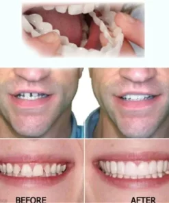 Oveallgo™ SMILE Adjustable Snap-On Dentures