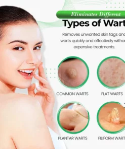 Oveallgo™ WartWipeout Soap