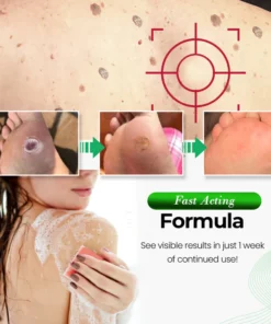 Oveallgo™ WartWipeout Soap