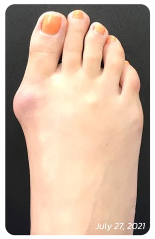 SUPTRUCK™ Orthopedic Bunion Relief Socks