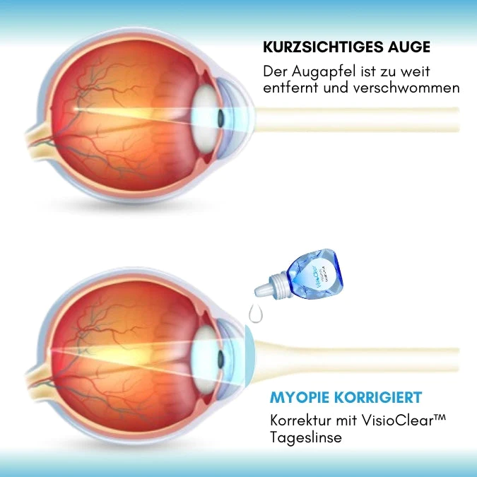 VisioClear™ Flüssige Tageslinse