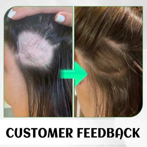Awzlove™ FolliHerb Hair Growth Spray