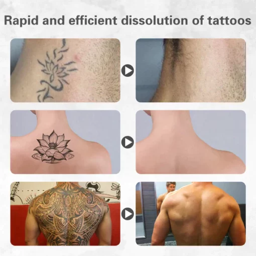 Fivfivgo ™ Tattoo-Auflösungsgel