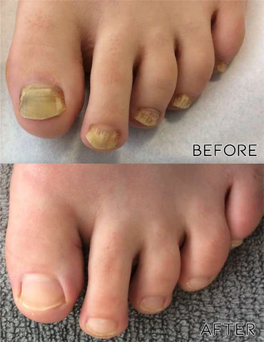 Fivfivgo™ Anti-Pilz-Nagelbehandlungsspray in medizinischer Qualität