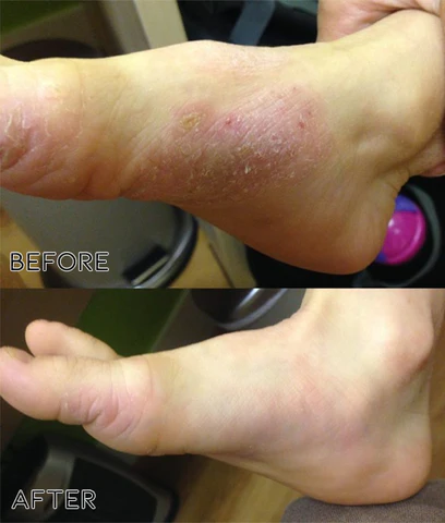 Fivfivgo™ Anti-Pilz-Nagelbehandlungsspray in medizinischer Qualität