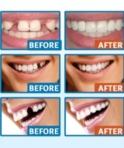 Fivfivgo™ Glory Smile Provisorisches Zahnbildhauer-Reparaturset