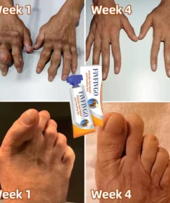 Fivfivgo™ Kanadisches Bienengift lindert Knochenschmerzen und repariert Knochenverletzungen Gel