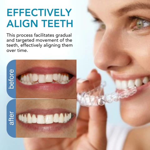 Fivfivgo™ Kieferorthopädie Begradigung Guard