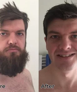 Fivfivgo™ Laser-Haarentferner