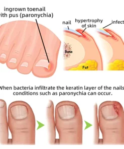 Fivfivgo™ Nagelpilz-Lasertherapiegerät Max