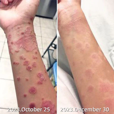 Fivfivgo™ Psoriasis-Behandlungsspray