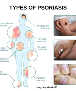 Fivfivgo™ Psoriasis-Behandlungsspray