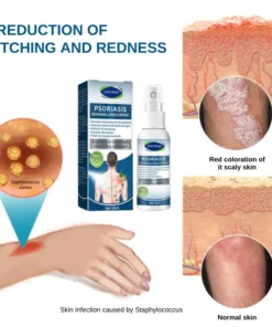 Fivfivgo™ Psoriasis-Behandlungsspray