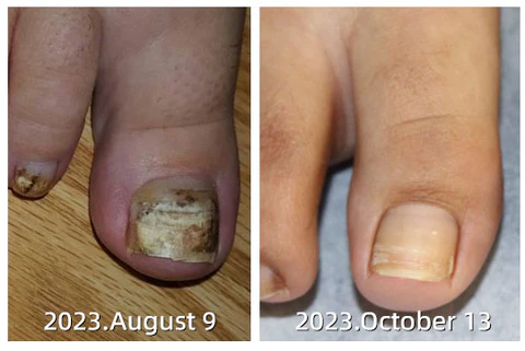 Fivfivgo™ Psoriasis Treatment Spray