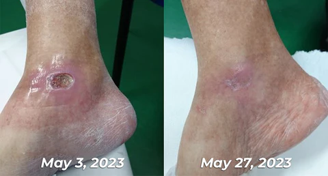 GFOUK™ GlycoWave Electric Pulse Device