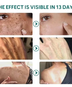 GFOUK™ Melanin Removal Booster Showerhead