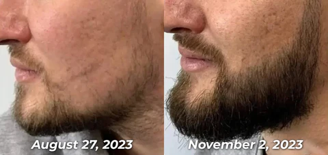 GFOUK™ PotentGRO Hair Treatment Roller - Image 7