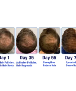 GFOUK™ PotentGRO Hair Treatment Roller