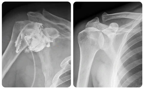 GFOUK™ ShoulderHeal Tourmaline Heating Compression Brace