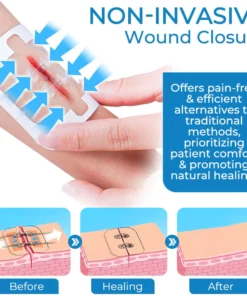 GFOUK™ StitchFree Closure Device