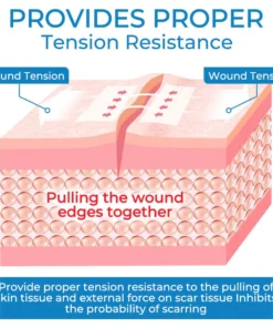 GFOUK™ StitchFree Closure Device