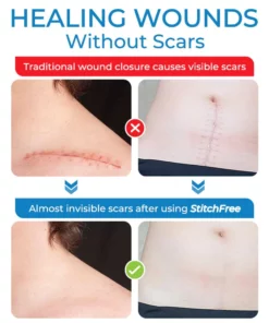 GFOUK™ StitchFree Closure Device