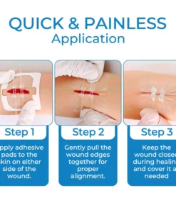 GFOUK™ StitchFree Closure Device