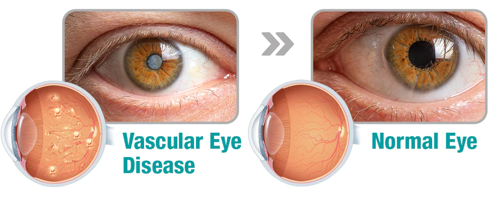 Hermsa™ OphthalPro Vision Enhancement Device