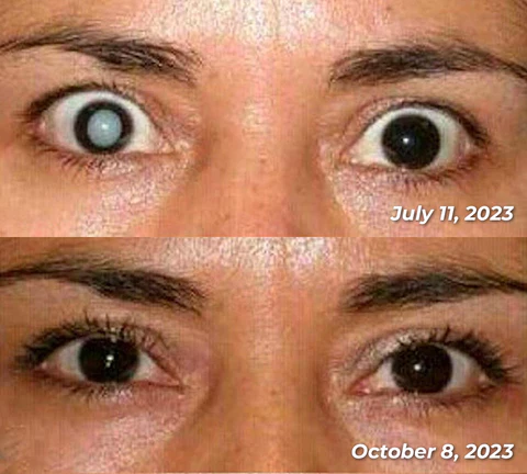 Hermsa™ OphthalPro Vision Enhancement Device