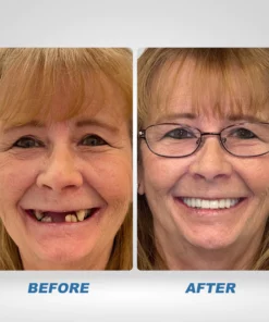 Instant Smile™ Temporary Teeth Kit