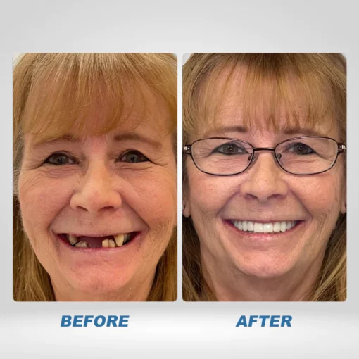 Instant Smile™ Temporary Teeth Kit