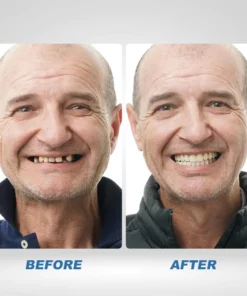 Instant Smile™ Temporary Teeth Kit