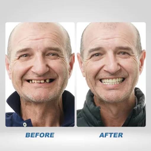 Instant Smile™ Temporary Teeth Kit