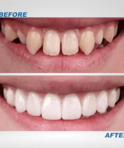 Instant Smile™ Temporary Teeth Kit