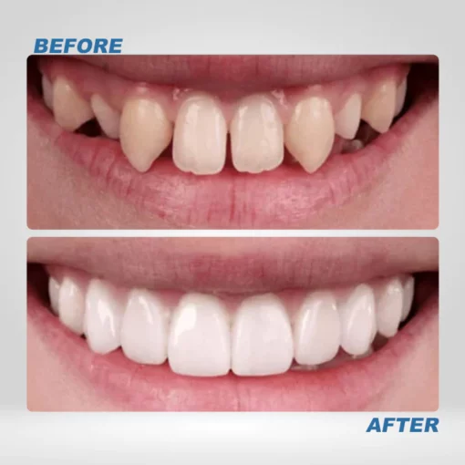 Instant Smile™ Temporary Teeth Kit