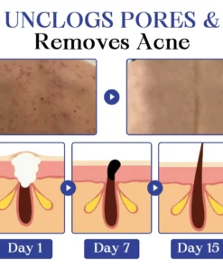 Kisshi™ Back Spots & Acanthosis Nigricans