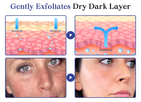 Kisshi™ Back Spots & Acanthosis Nigricans