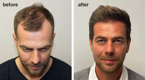 LIMETOW™ Anti-Hair Loss Ginger Shampoo Soap