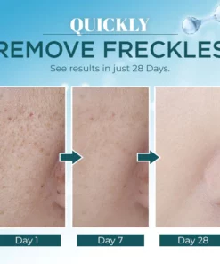 Lanthome™ Dark Spot Remover