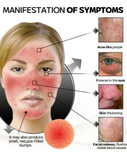 Ourlyard™ Laser Treatment Facial Mask for Rosacea