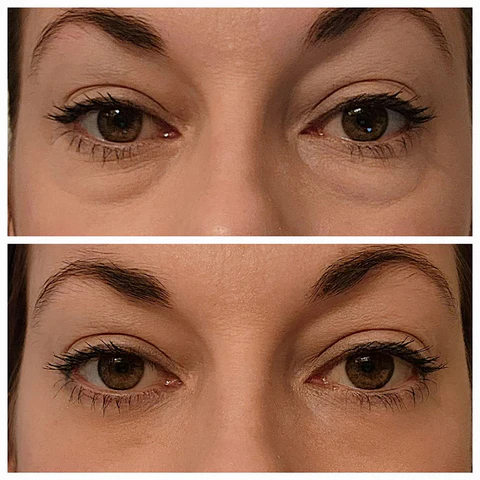 Oveallgo™ Clinical SkinCare مستحضر شد العين الفوري