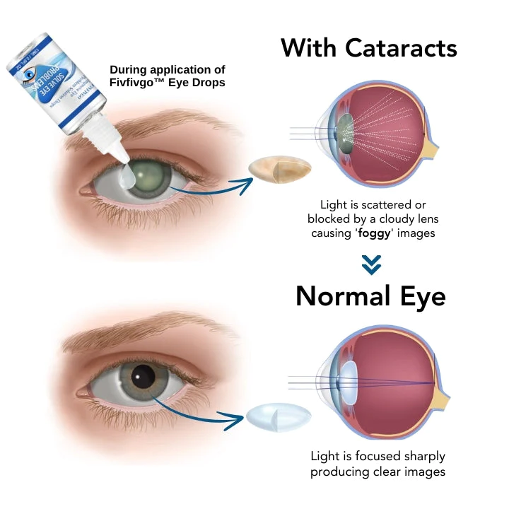 Oveallgo™ Myopia Reversal Eye Drops