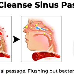 Oveallgo™ ProX Freshing Nasal Mucus Cleaning Device