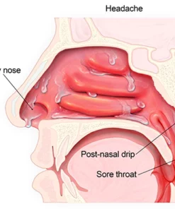 Oveallgo™ ULTRA Nasal Mucus Cleaning Device