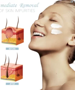 Penghilang Kutil Herba RICPIND SkinSpot